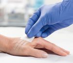 Hartmann Omnistrip Sterile Wundnahtstreifen (Anwendungsbeispiel)