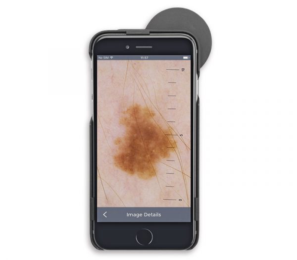 Heine iC1 Dermatoskop für iPhone – Displayansicht (Anwendungsbeispiel)