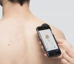 Heine iC1 Dermatoskop für iPhone (Anwendungsbeispiel)