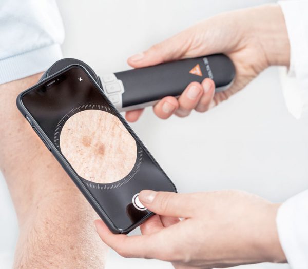Heine DELTA 30 LED-Dermatoskop (Anwendungsbeispiel mit Smartphone und Adapterschale)