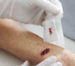 BSN medical Leukoplast Leukomed skin sensitive Wundverband (Anwendungsbeispiel)