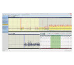 Amedtec EP830 Langzeit-EKG – Bildschirmansicht Schnelle Detektion von VH-Arrhythmien