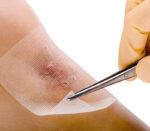 Essity / BSN Cutimed Cuticell, Salbenkompresse steril, Anwendungsbeispiel