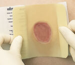 Urgo Algoplaque Hydrokolloidverband, Anwendung Hüfte