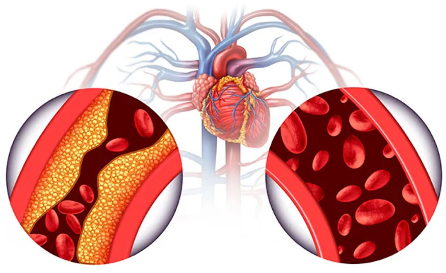 Diagnose der Koronaren Herzkrankheit