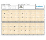 Getemed PhysioMem PM 100 4G mobiles Tele-EKG – EKG-Report
