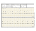 Getemed CardioMem CM 100 XT EKG-Loop-Rekorder PGA Kit – EKG-Report