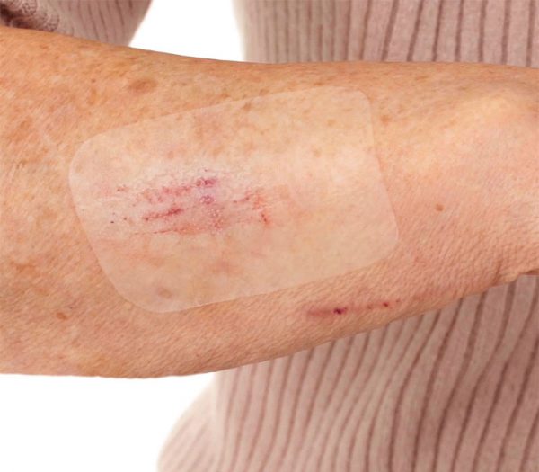 BSN medical Leukoplast Leukomed T skin sensitive Transparentverband (Anwendungsbeispiel)