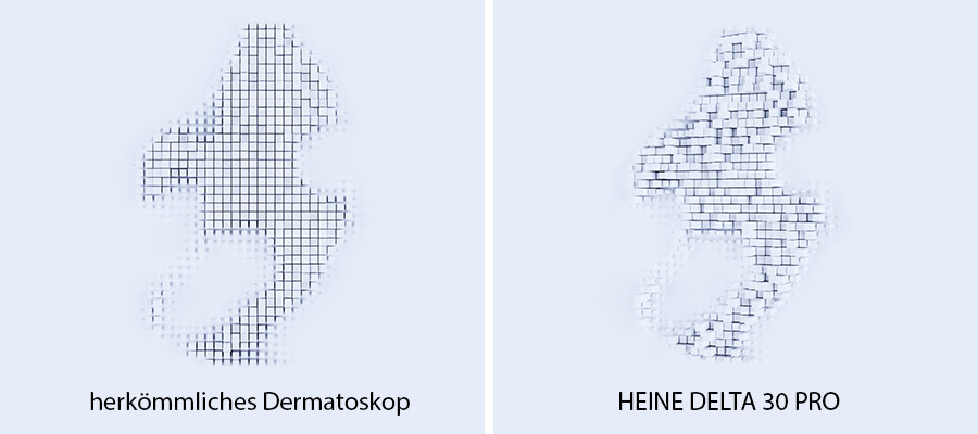 Vergleichsansicht der räumlichen Darstellung des Heine Delta 30 Pro im Vergleich zu einem herkömmlichen Dermatoskop