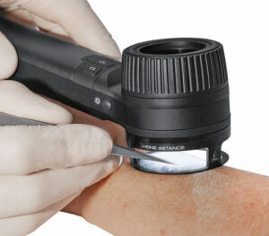 Heine diSTANCE Arbeitsring für DELTA 30 Pro Dermatoskop (Anwendungsbeispiel)
